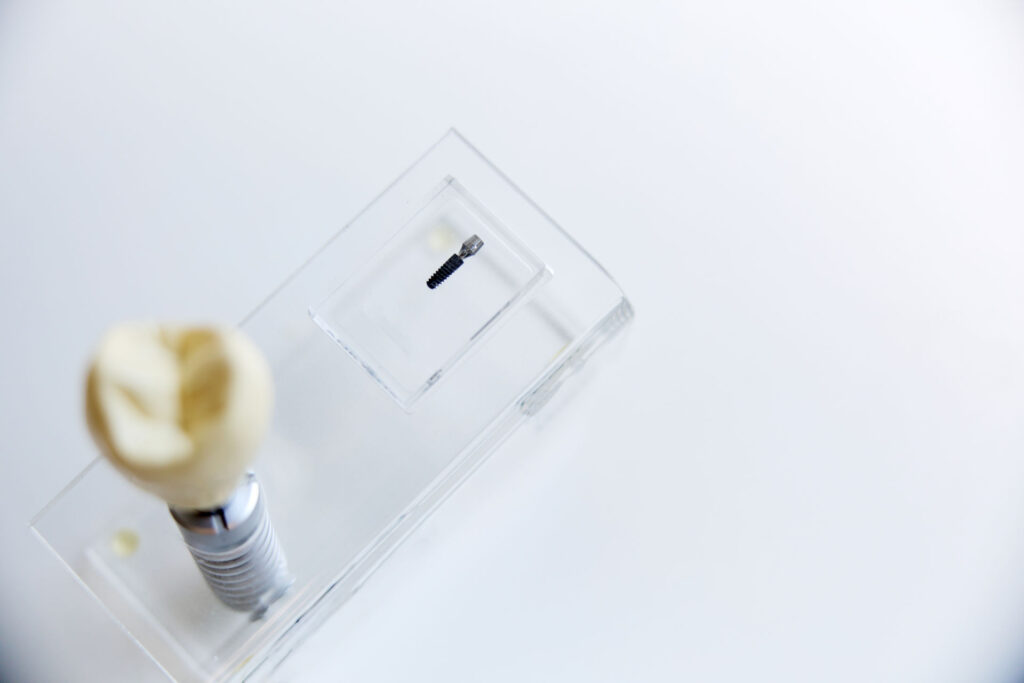 Zahnimplantat mit Krone als Beispiel für hochwertige Implantatversorgung